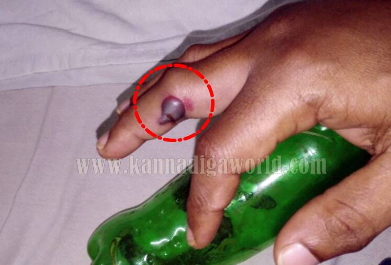 kundapura_bhatkala_snake-bite-1