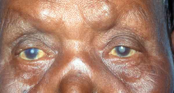 cataract_eye_pic1