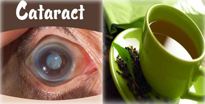 catract_eye_green_tea